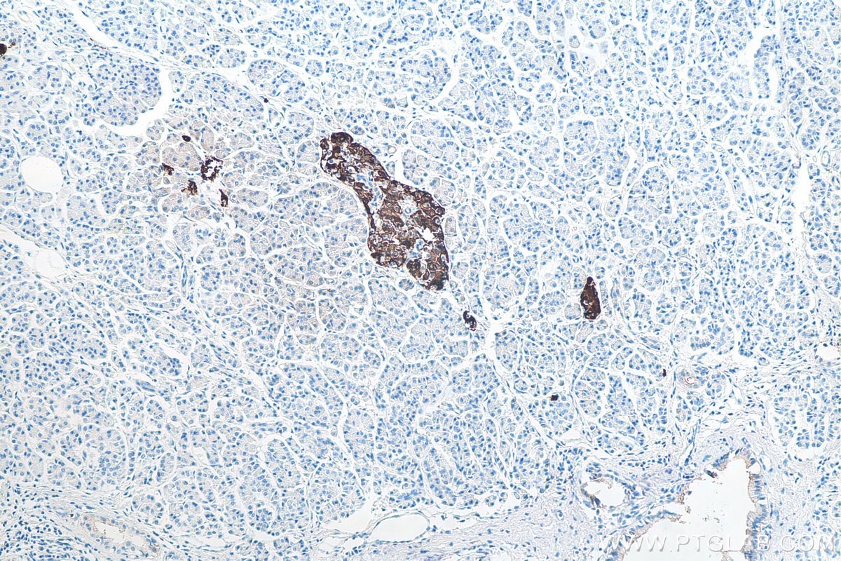 Immunohistochemical analysis of paraffin-embedded human pancreas cancer tissue slide using KHC0004 (Insulin IHC Kit).