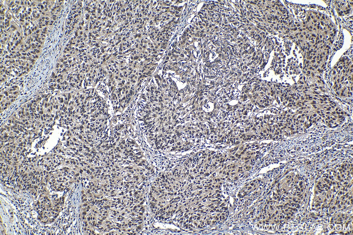 Immunohistochemical analysis of paraffin-embedded human cervical cancer tissue slide using KHC1248 (IPO7 IHC Kit).