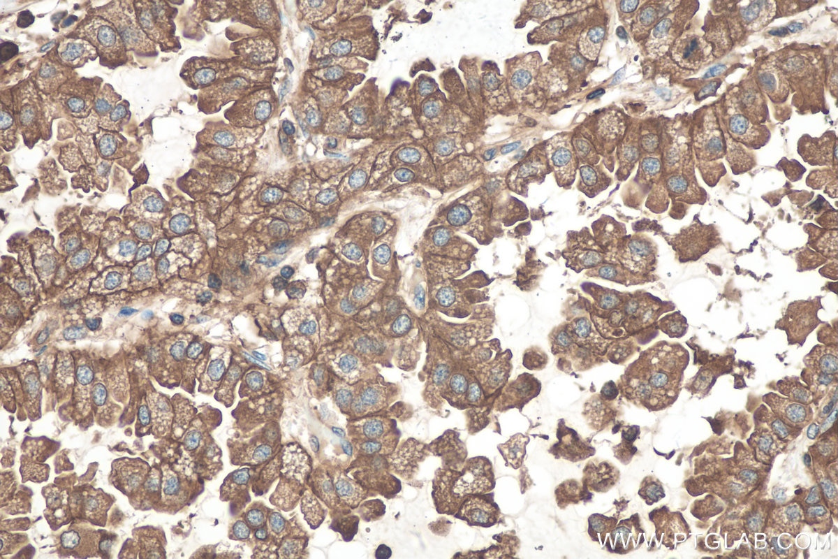 Immunohistochemical analysis of paraffin-embedded human lung cancer tissue slide using KHC0678 (IQGAP1 IHC Kit).