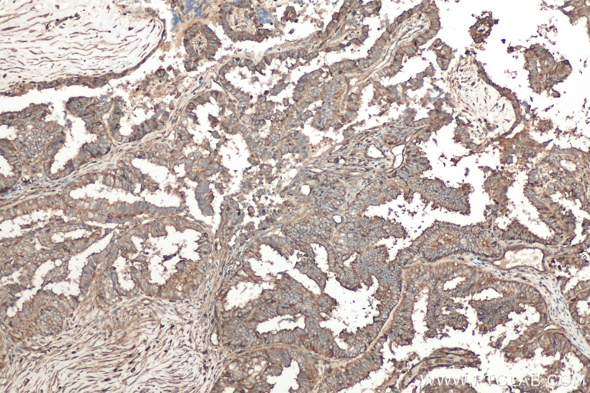 Immunohistochemical analysis of paraffin-embedded human ovary tumor tissue slide using KHC0678 (IQGAP1 IHC Kit).