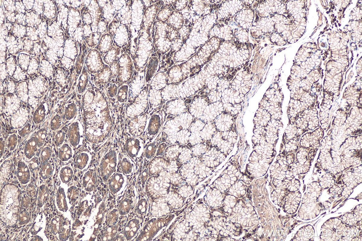 Immunohistochemical analysis of paraffin-embedded human stomach cancer tissue slide using KHC0678 (IQGAP1 IHC Kit).