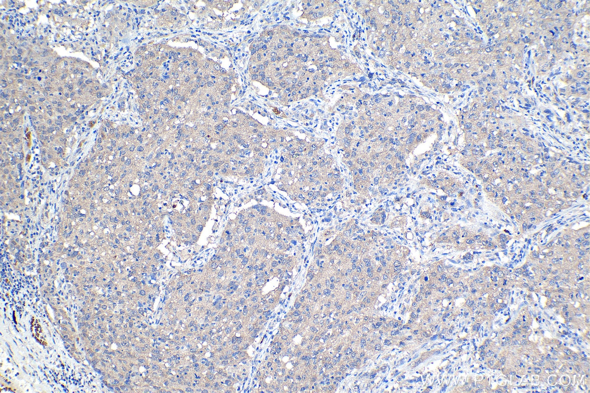 Immunohistochemical analysis of paraffin-embedded human lung cancer tissue slide using KHC1136 (IRAK3 IHC Kit).