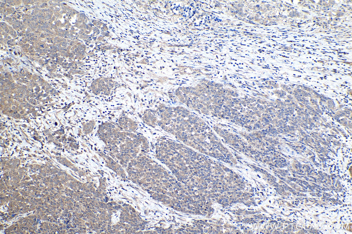 Immunohistochemical analysis of paraffin-embedded human ovary tumor tissue slide using KHC1136 (IRAK3 IHC Kit).