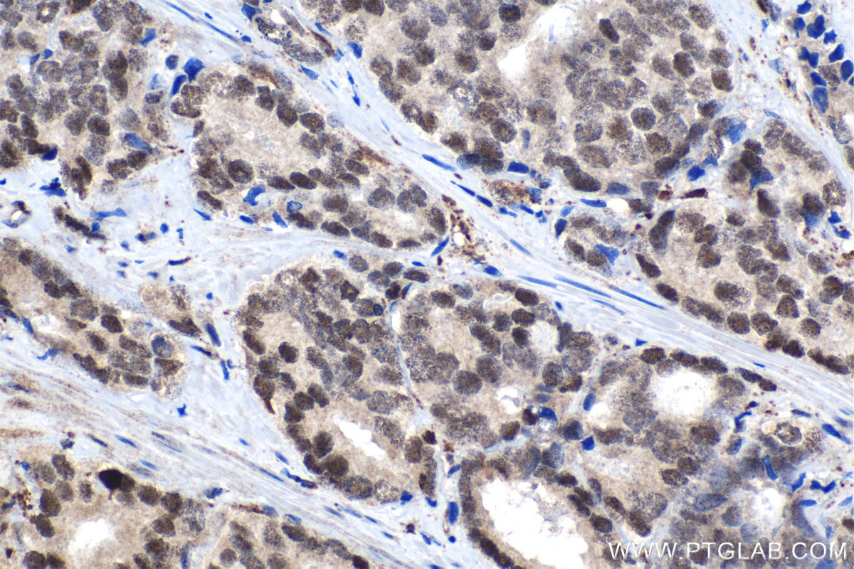 Immunohistochemical analysis of paraffin-embedded human prostate cancer tissue slide using KHC1531 (IRF2 IHC Kit).