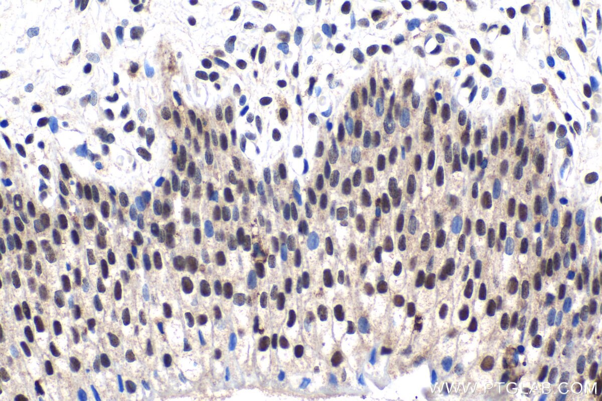 Immunohistochemical analysis of paraffin-embedded human urothelial carcinoma tissue slide using KHC1531 (IRF2 IHC Kit).