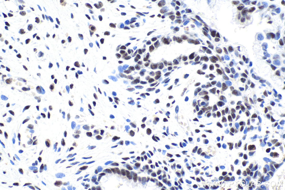 Immunohistochemical analysis of paraffin-embedded human cervical cancer tissue slide using KHC1813 (IRF2BP1 IHC Kit).