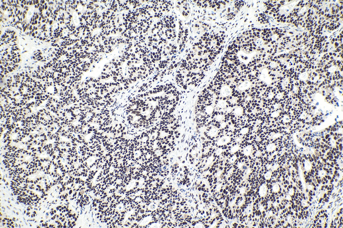 Immunohistochemical analysis of paraffin-embedded human ovary tumor tissue slide using KHC1813 (IRF2BP1 IHC Kit).