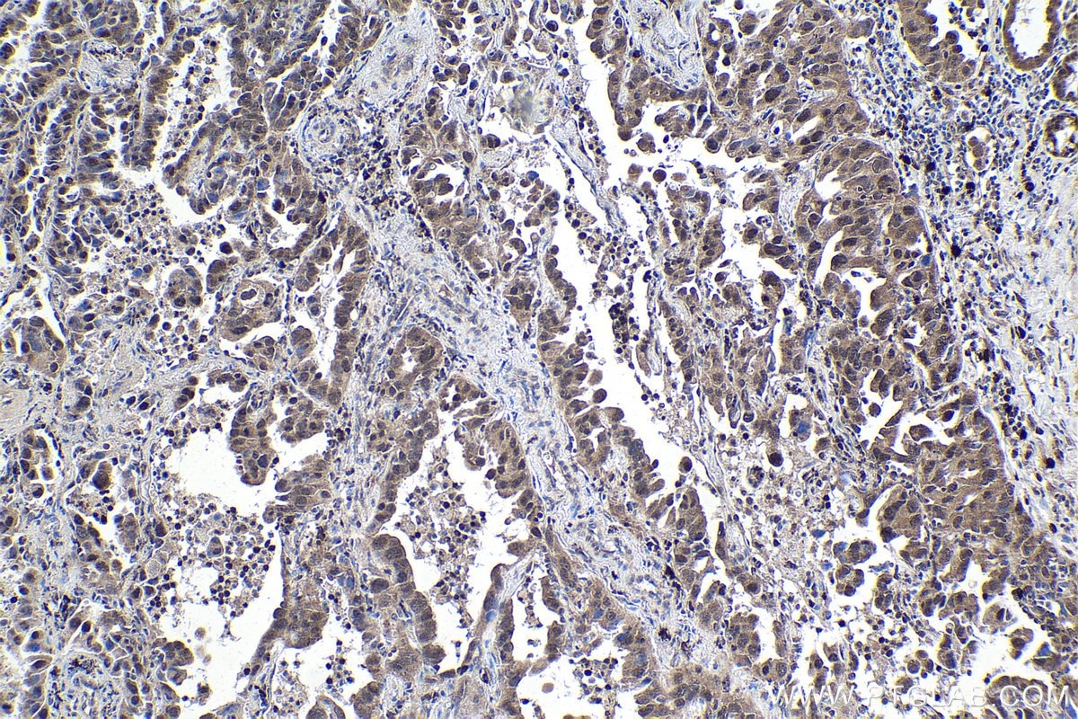 Immunohistochemical analysis of paraffin-embedded human lung cancer tissue slide using KHC1804 (IRF2BP2 IHC Kit).