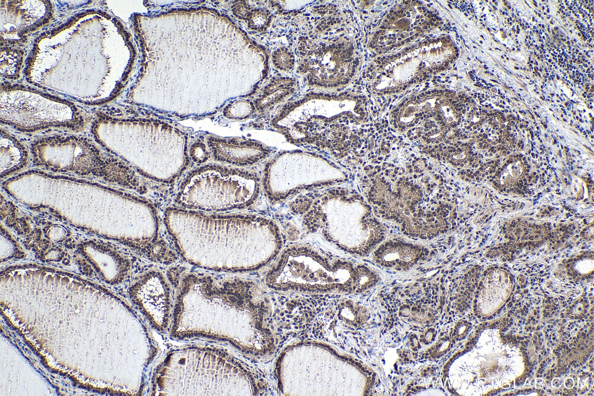 Immunohistochemical analysis of paraffin-embedded human thyroid cancer tissue slide using KHC1804 (IRF2BP2 IHC Kit).