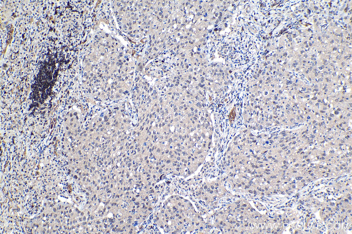 Immunohistochemical analysis of paraffin-embedded human lung cancer tissue slide using KHC1137 (IRF3 IHC Kit).