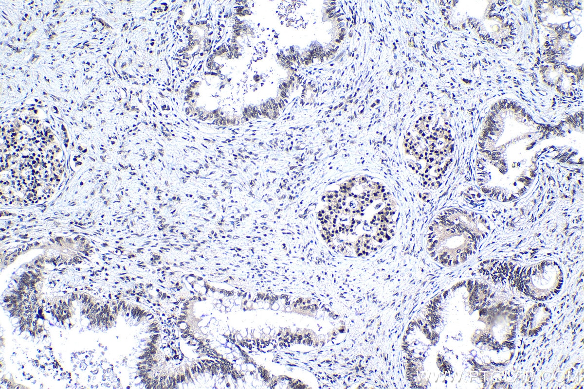 Immunohistochemical analysis of paraffin-embedded human pancreas cancer tissue slide using KHC1137 (IRF3 IHC Kit).
