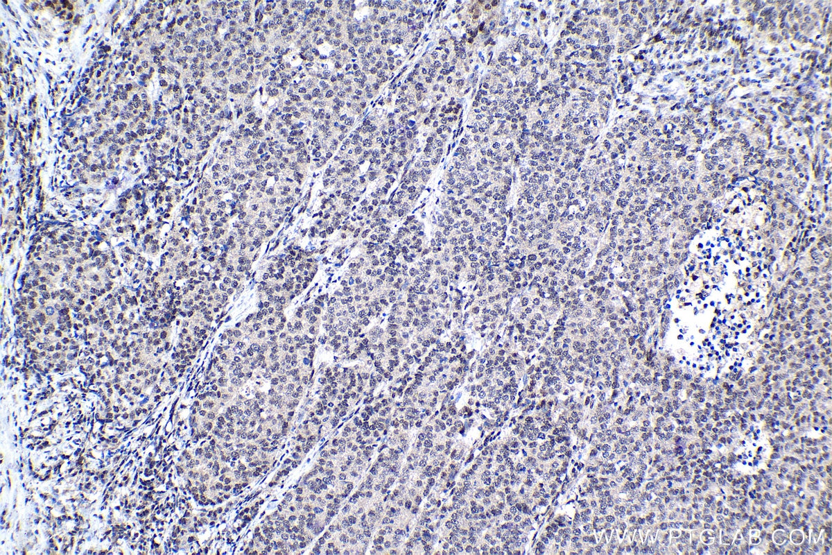 Immunohistochemical analysis of paraffin-embedded human stomach cancer tissue slide using KHC1137 (IRF3 IHC Kit).