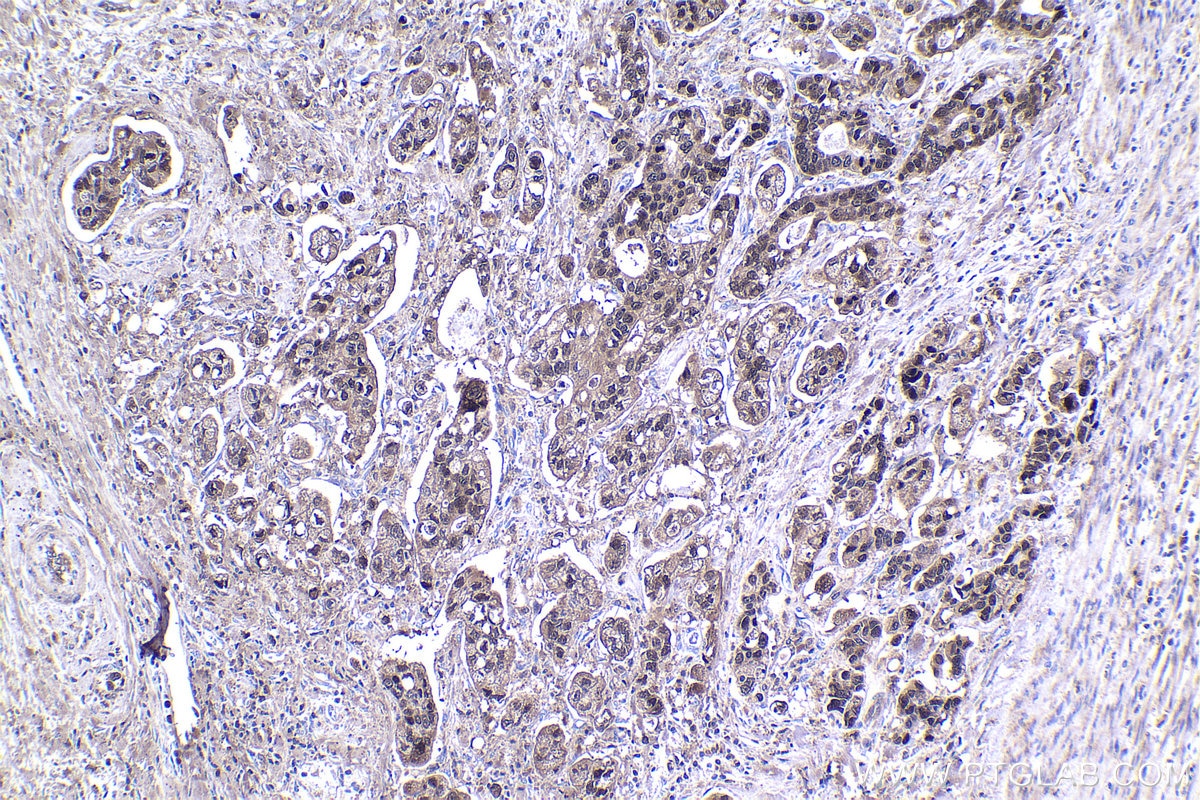 Immunohistochemical analysis of paraffin-embedded human stomach cancer tissue slide using KHC1431 (IRF6 IHC Kit).