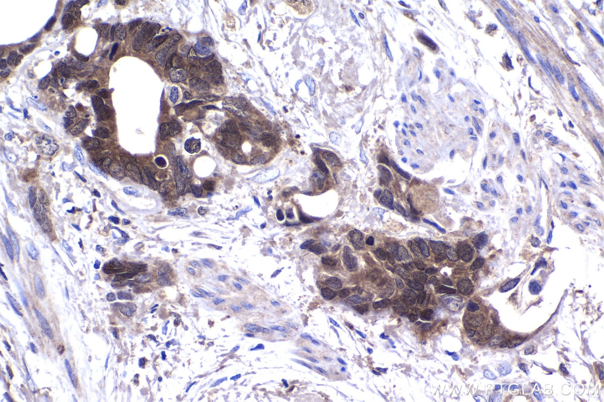 Immunohistochemical analysis of paraffin-embedded human urothelial carcinoma tissue slide using KHC1431 (IRF6 IHC Kit).