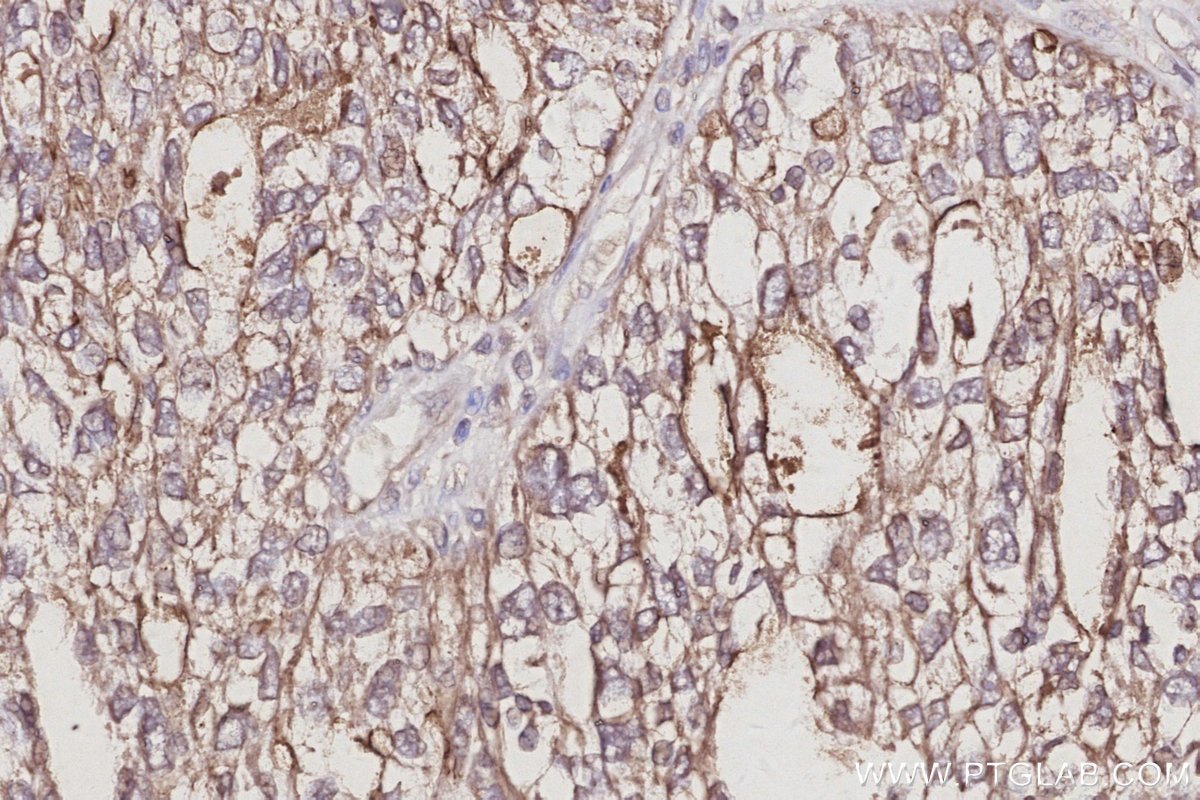 Immunohistochemical analysis of paraffin-embedded human ovary cancer tissue slide using KHC3049 (IRSp53 IHC Kit). Immunohistochemical analysis of paraffin-embedded human ovary cancer tissue slide using KHC3049 (IRSp53 IHC Kit).