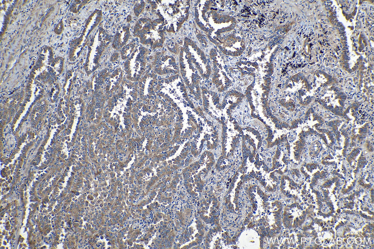 Immunohistochemical analysis of paraffin-embedded human lung cancer tissue slide using KHC1259 (ISCU IHC Kit).