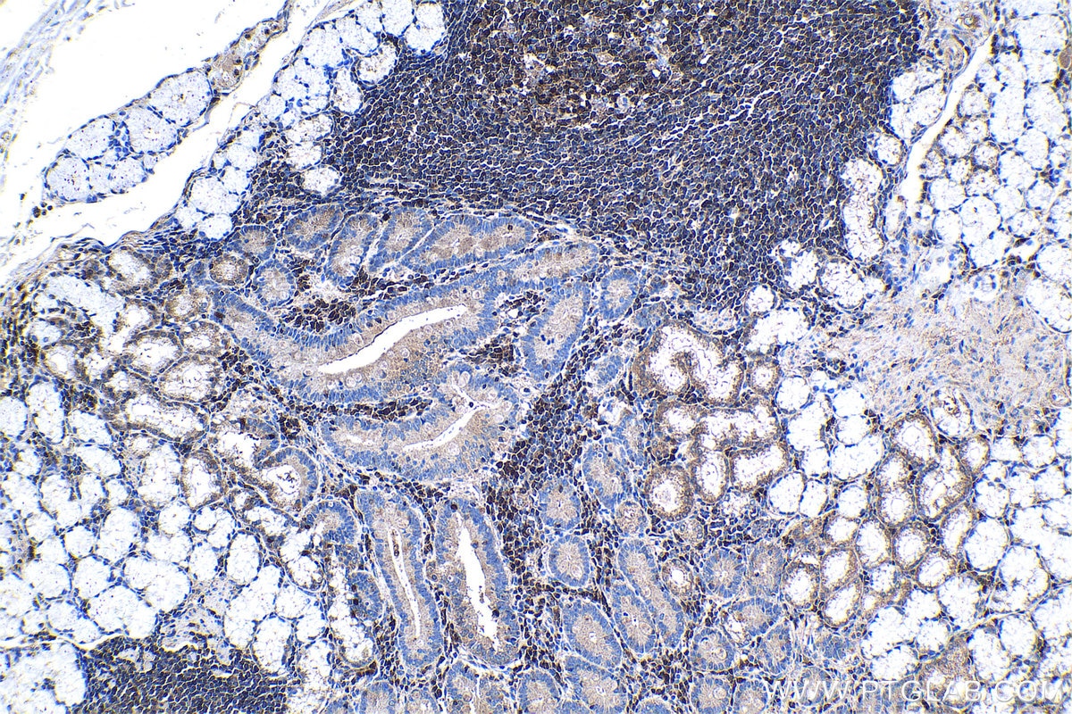 Immunohistochemical analysis of paraffin-embedded human stomach cancer tissue slide using KHC1342 (ISG20 IHC Kit).