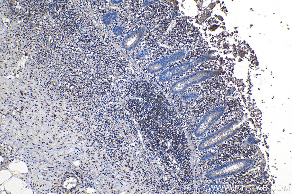 Immunohistochemical analysis of paraffin-embedded human appendicitis tissue slide using KHC1342 (ISG20 IHC Kit).