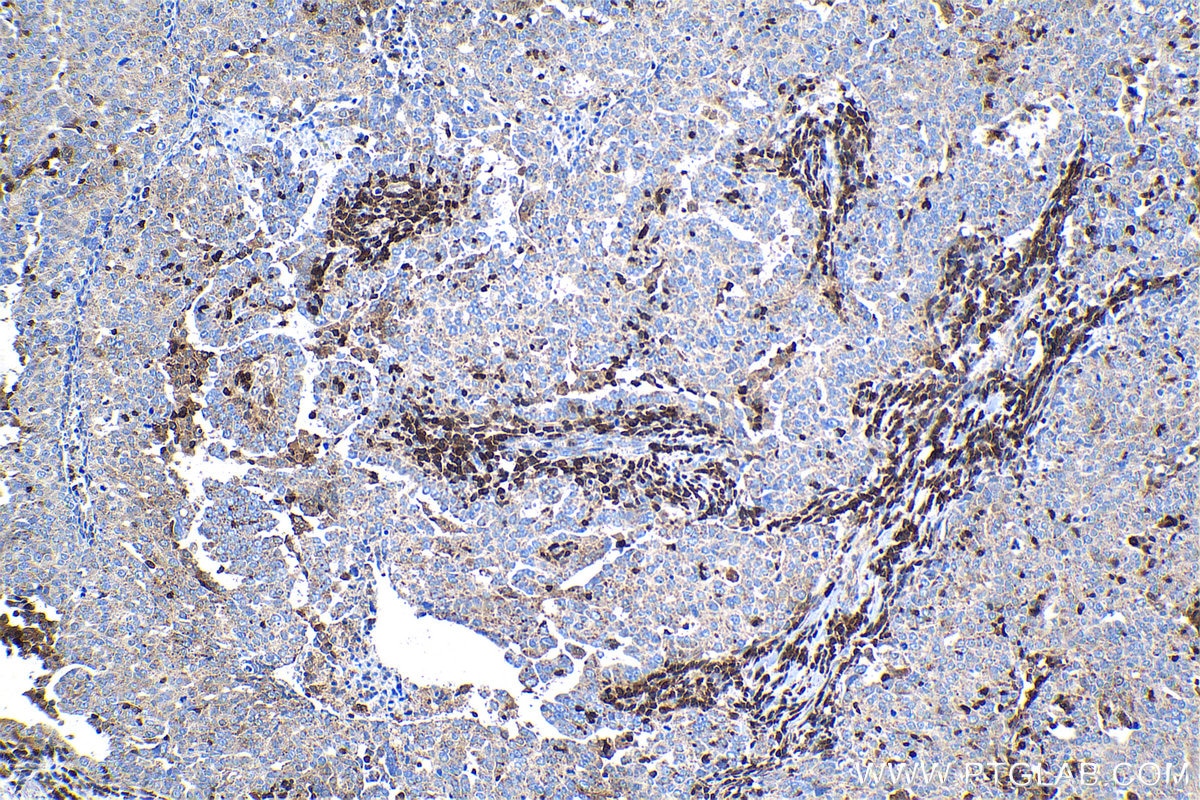 Immunohistochemical analysis of paraffin-embedded human ovary tumor tissue slide using KHC1342 (ISG20 IHC Kit).