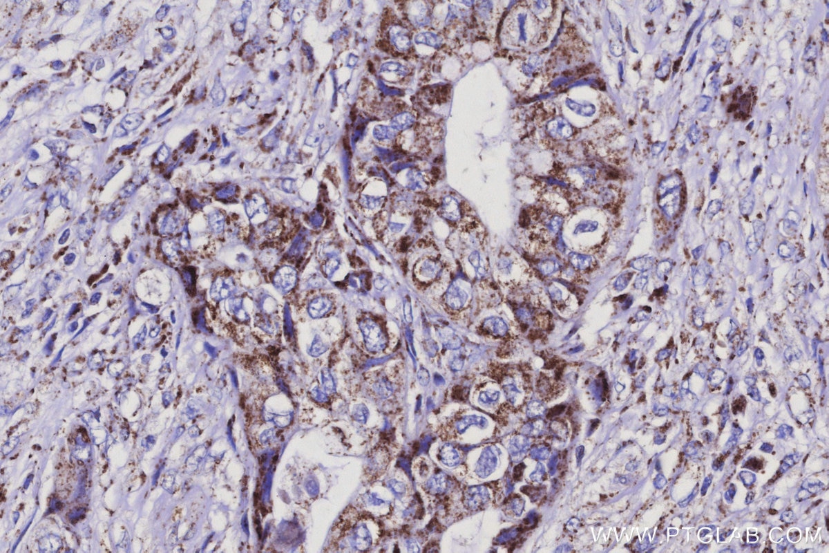 Immunohistochemical analysis of paraffin-embedded human pancreas cancer tissue slide using KHC3129 (ISOC2 IHC Kit).