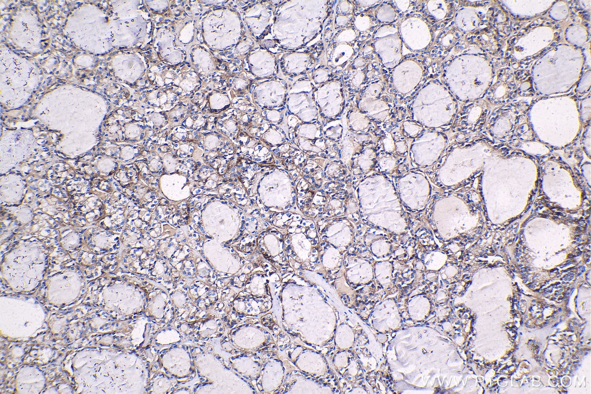 Immunohistochemical analysis of paraffin-embedded human thyroid cancer tissue slide using KHC1334 (ITGA3 IHC Kit).