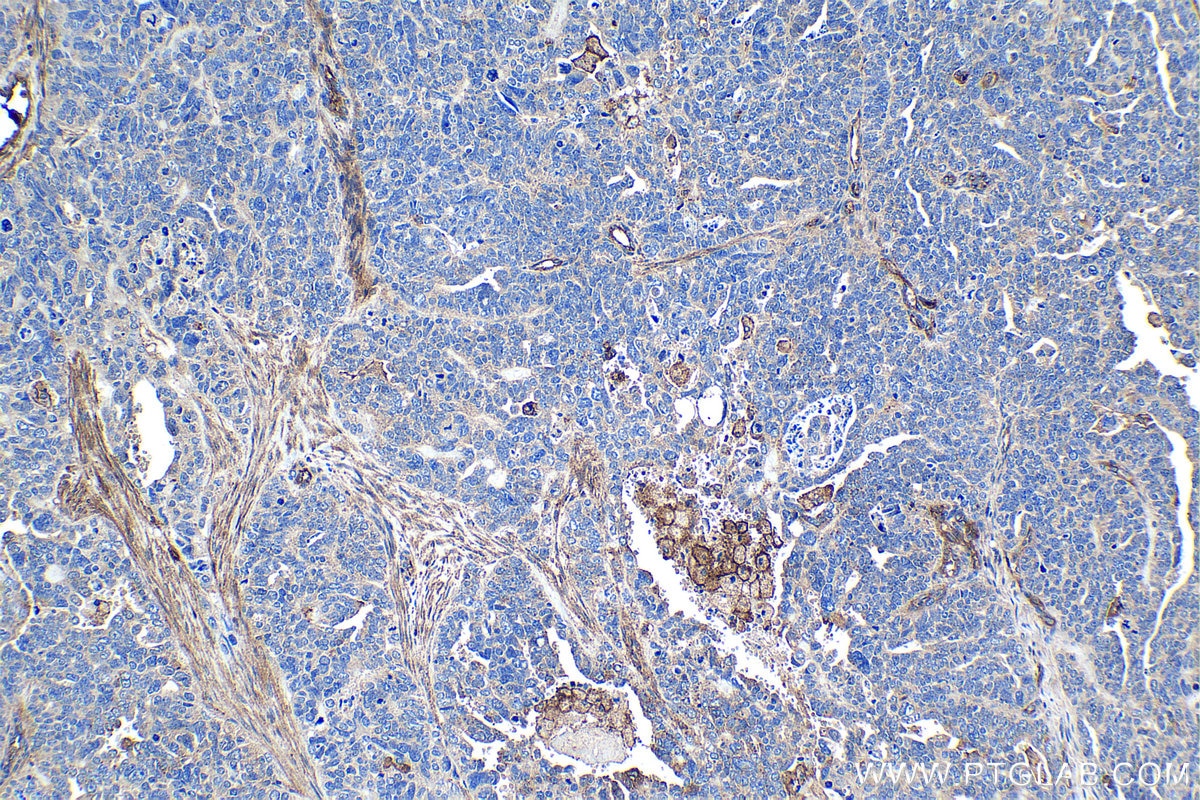 Immunohistochemical analysis of paraffin-embedded human ovary tumor tissue slide using KHC1228 (ITGA5 IHC Kit).
