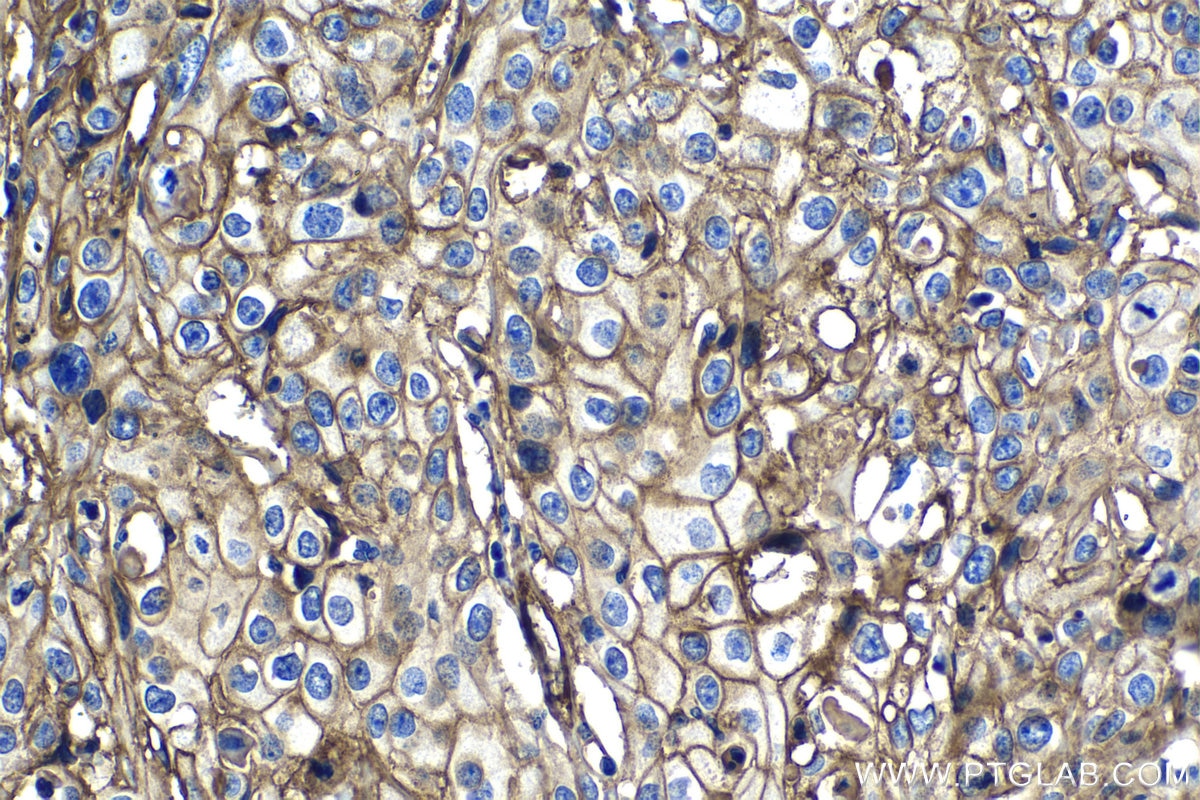 Immunohistochemical analysis of paraffin-embedded human cervical cancer tissue slide using KHC1228 (ITGA5 IHC Kit).