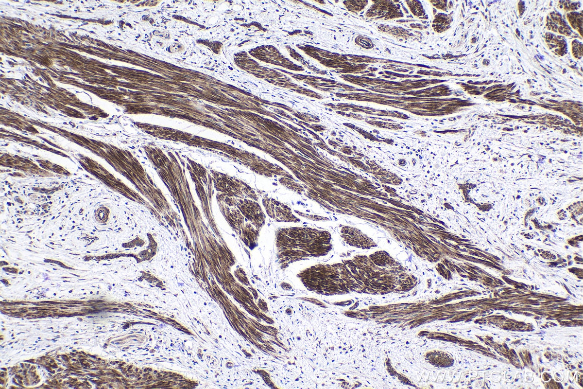 Immunohistochemical analysis of paraffin-embedded human urothelial carcinoma tissue slide using KHC1711 (ITGB3BP IHC Kit).