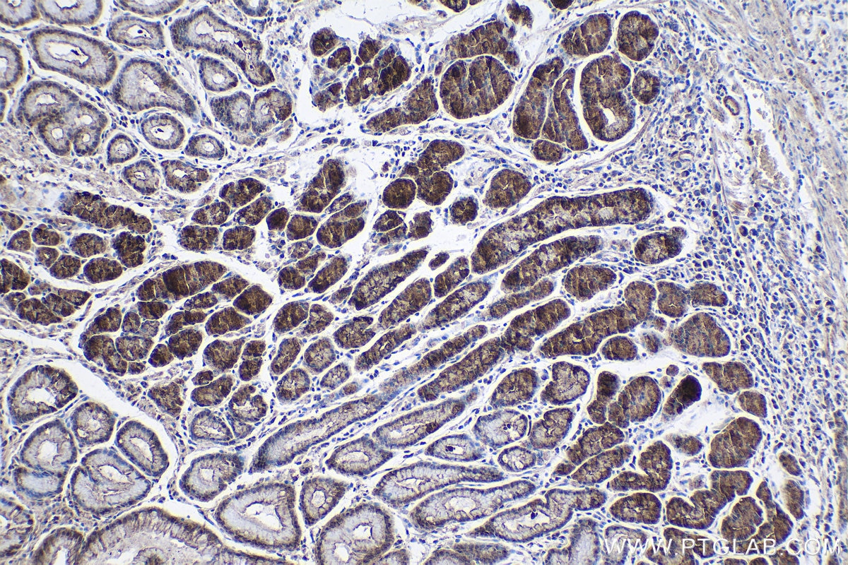 Immunohistochemical analysis of paraffin-embedded human stomach cancer tissue slide using KHC1711 (ITGB3BP IHC Kit).
