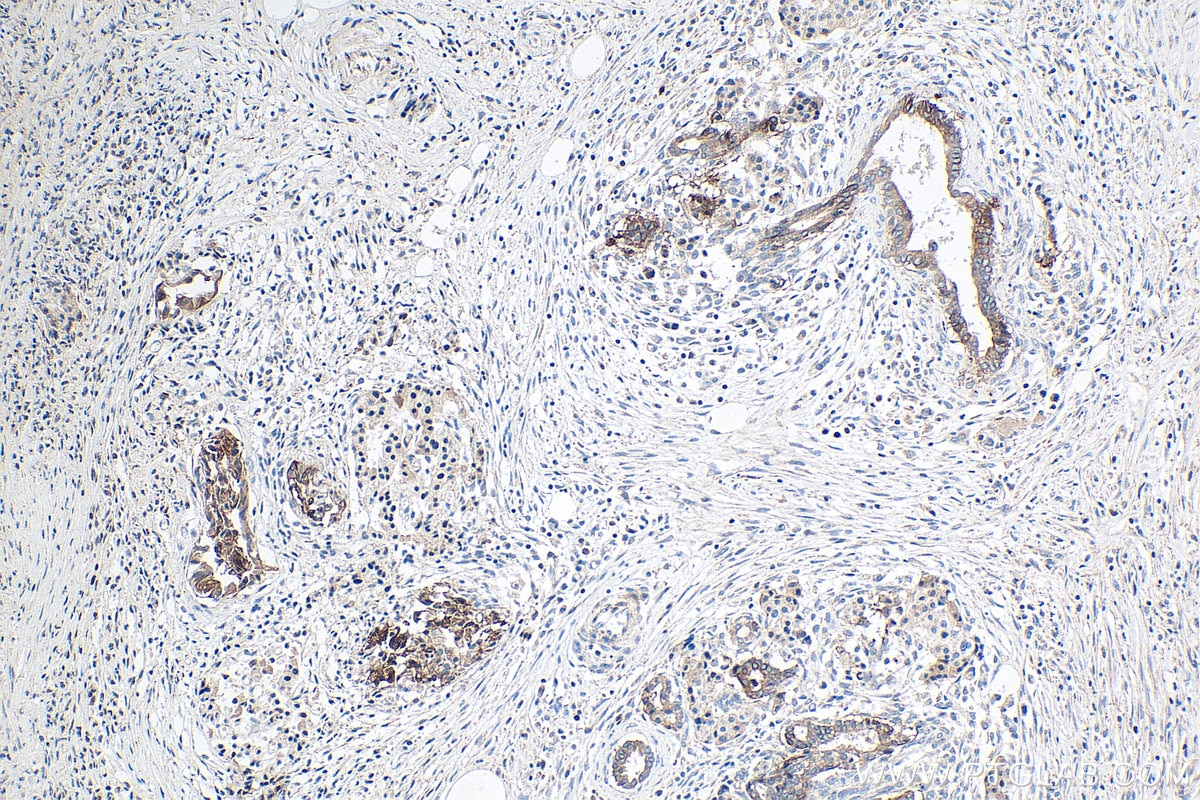 Immunohistochemical analysis of paraffin-embedded human pancreas cancer tissue slide using KHC0221 (Integrin Beta 6 IHC Kit).