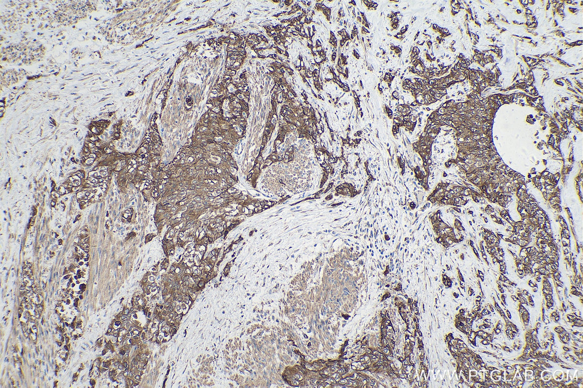 Immunohistochemical analysis of paraffin-embedded human urothelial carcinoma tissue slide using KHC0221 (Integrin Beta 6 IHC Kit).