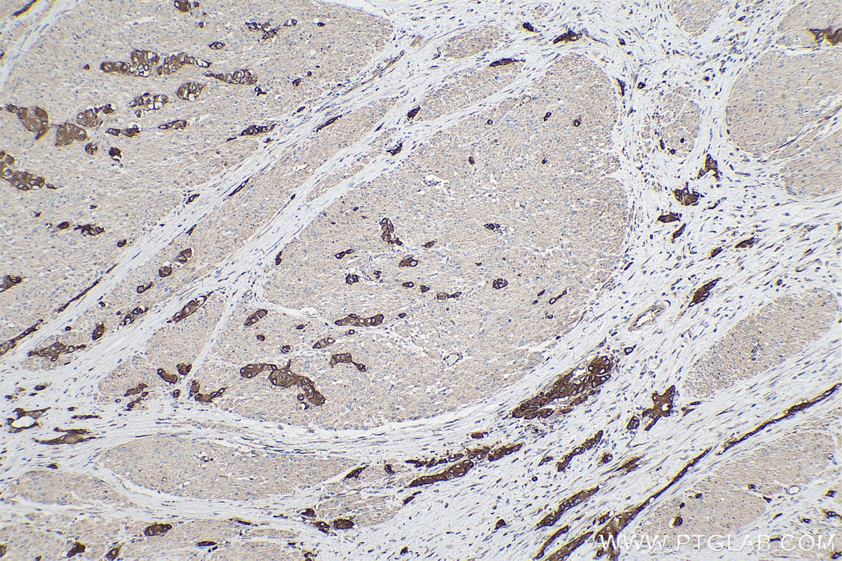 Immunohistochemical analysis of paraffin-embedded human urothelial carcinoma tissue slide using KHC0221 (Integrin Beta 6 IHC Kit).