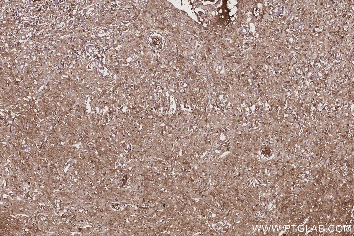 Immunohistochemical analysis of paraffin-embedded human colon cancer tissue slide using KHC3196 (ITIH1 IHC Kit). Immunohistochemical analysis of paraffin-embedded human colon cancer tissue slide using KHC3196 (ITIH1 IHC Kit).