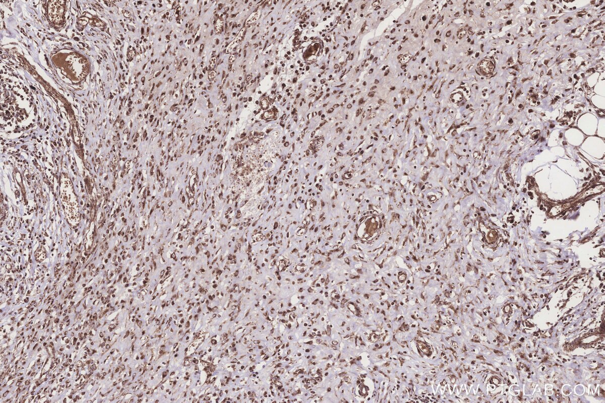 Immunohistochemical analysis of paraffin-embedded human colon cancer tissue slide using KHC3202 (IVD IHC Kit). Immunohistochemical analysis of paraffin-embedded human colon cancer tissue slide using KHC3202 (IVD IHC Kit).