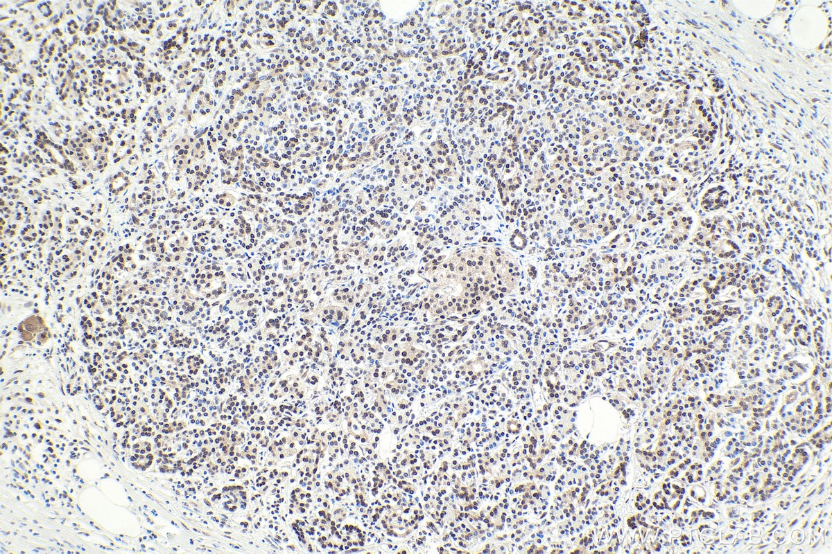 Immunohistochemical analysis of paraffin-embedded human pancreas cancer tissue slide using KHC1885 (IWS1 IHC Kit).