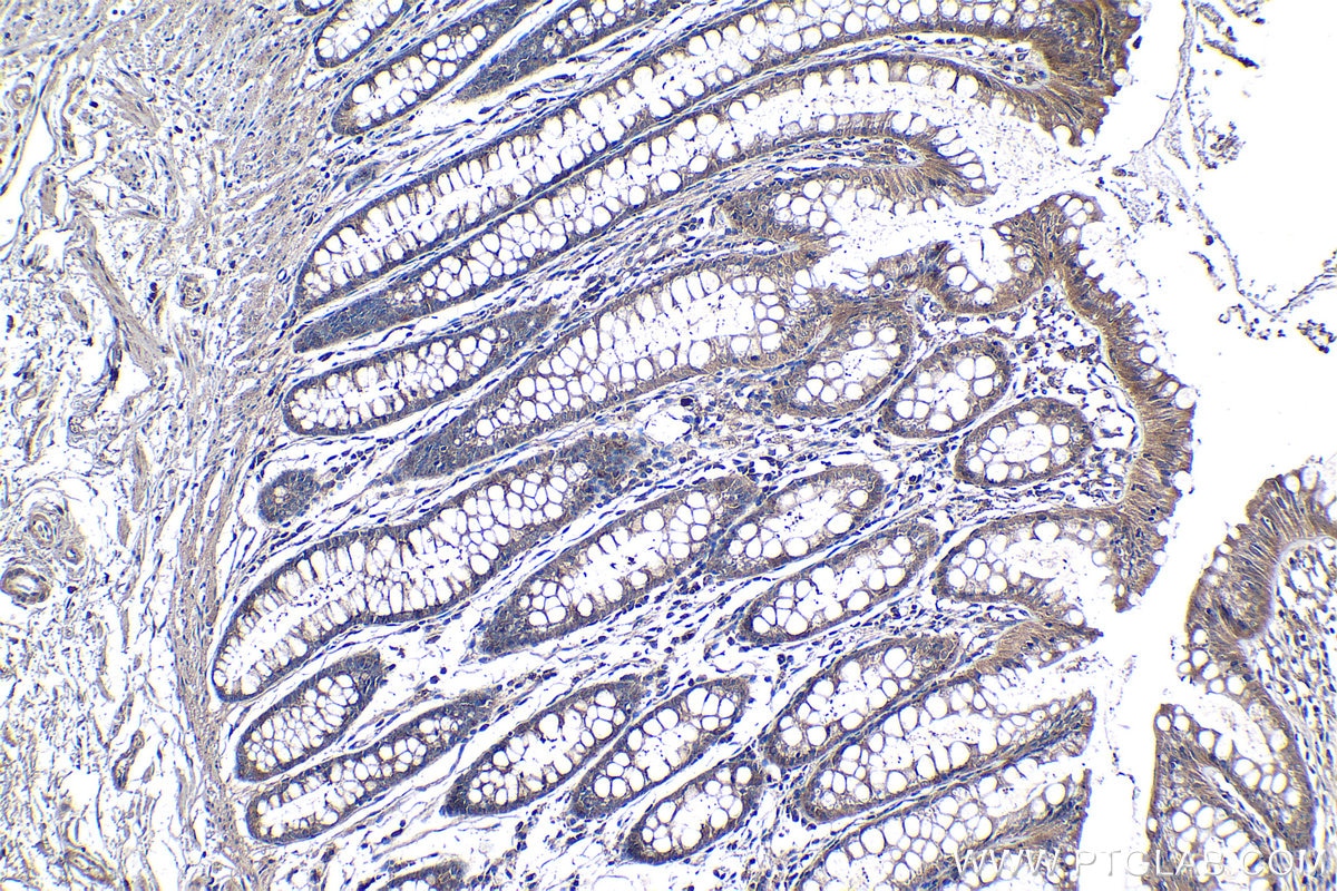 Immunohistochemical analysis of paraffin-embedded human colon tissue slide using KHC1264 (JAK1 IHC Kit).