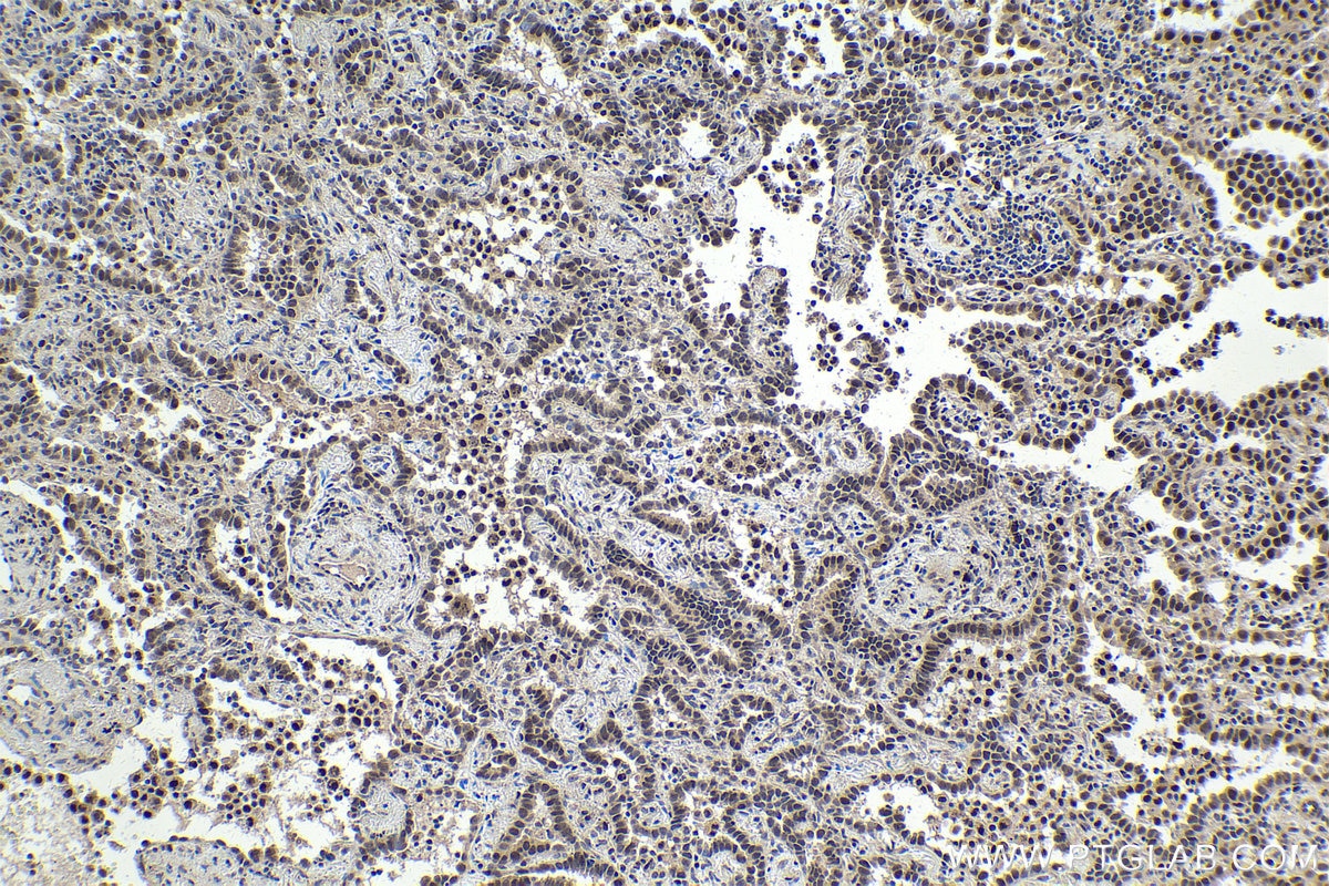 Immunohistochemical analysis of paraffin-embedded human lung cancer tissue slide using KHC1788 (JMJD6 IHC Kit).