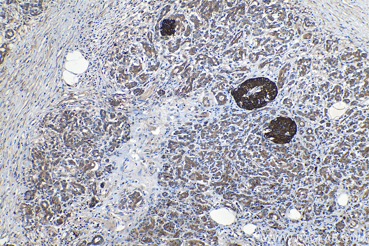 Immunohistochemical analysis of paraffin-embedded human pancreas cancer tissue slide using KHC1267 (JMY IHC Kit).