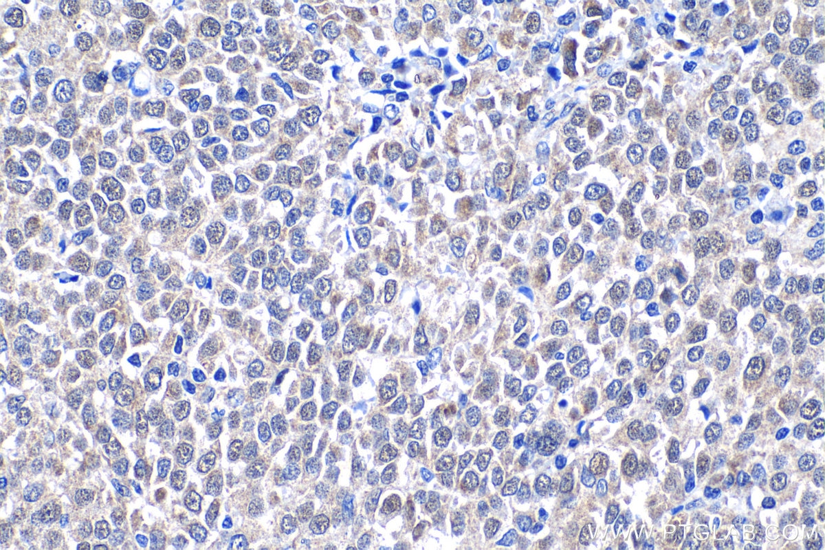 Immunohistochemical analysis of paraffin-embedded human ovary tumor tissue slide using KHC1267 (JMY IHC Kit).
