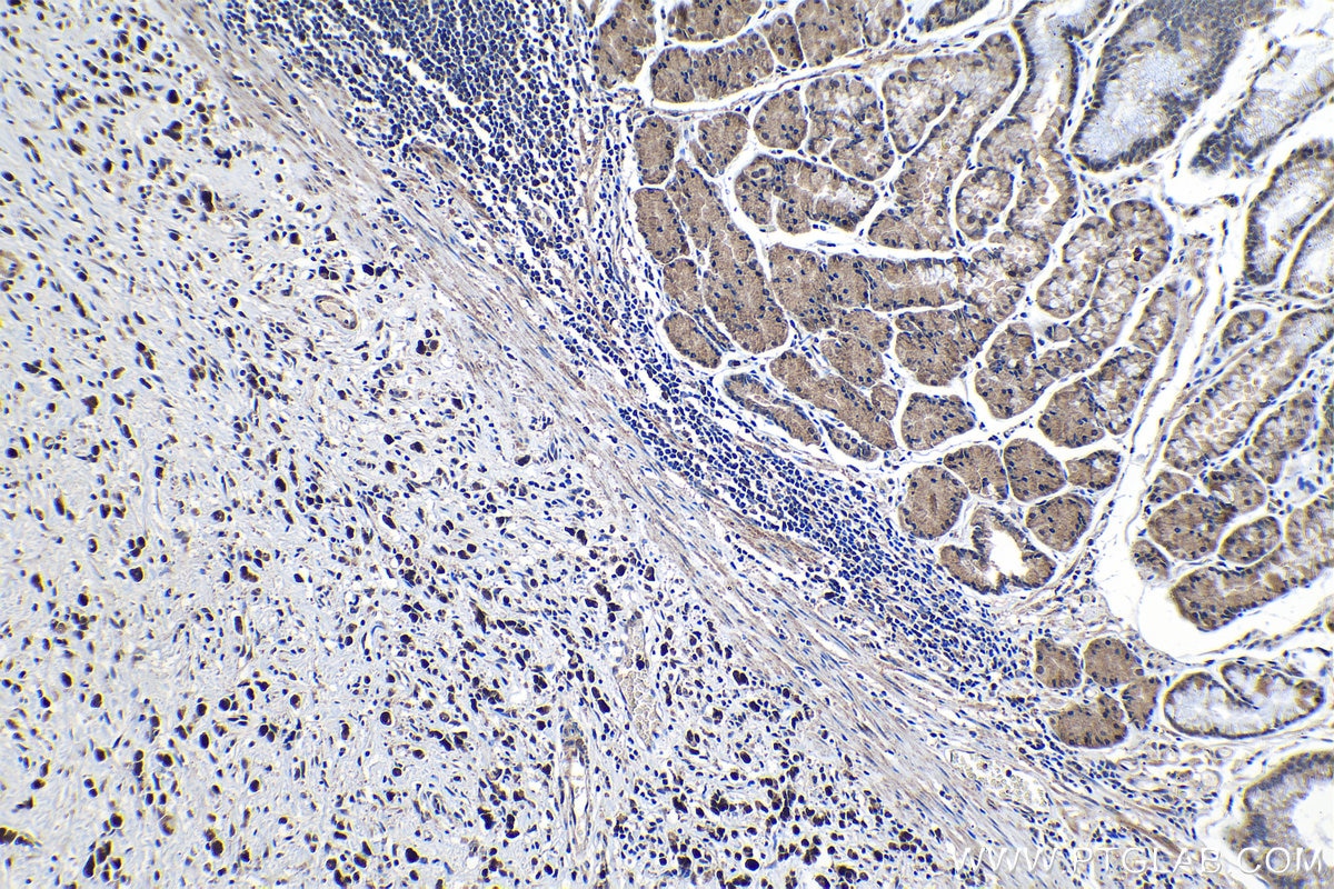 Immunohistochemical analysis of paraffin-embedded human stomach cancer tissue slide using KHC1267 (JMY IHC Kit).