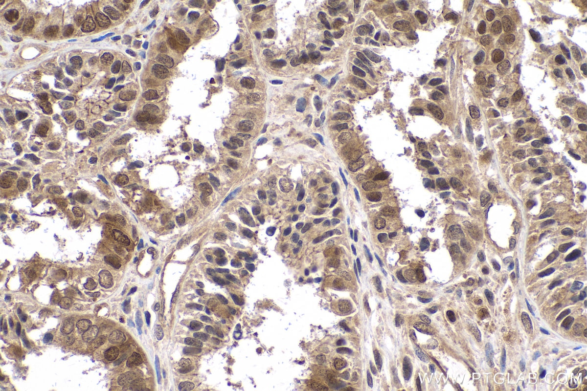 Immunohistochemical analysis of paraffin-embedded human ovary tumor tissue slide using KHC0846 (JPT1/HN1 IHC Kit).