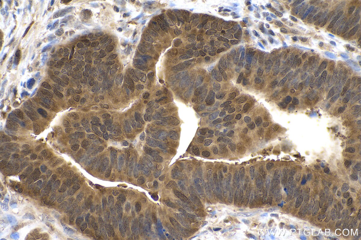 Immunohistochemical analysis of paraffin-embedded human colon cancer tissue slide using KHC0846 (JPT1/HN1 IHC Kit).