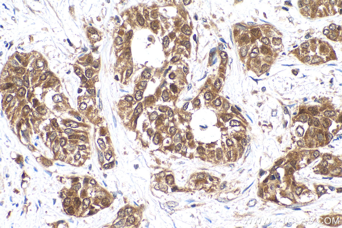 Immunohistochemical analysis of paraffin-embedded human urothelial carcinoma tissue slide using KHC0846 (JPT1/HN1 IHC Kit).