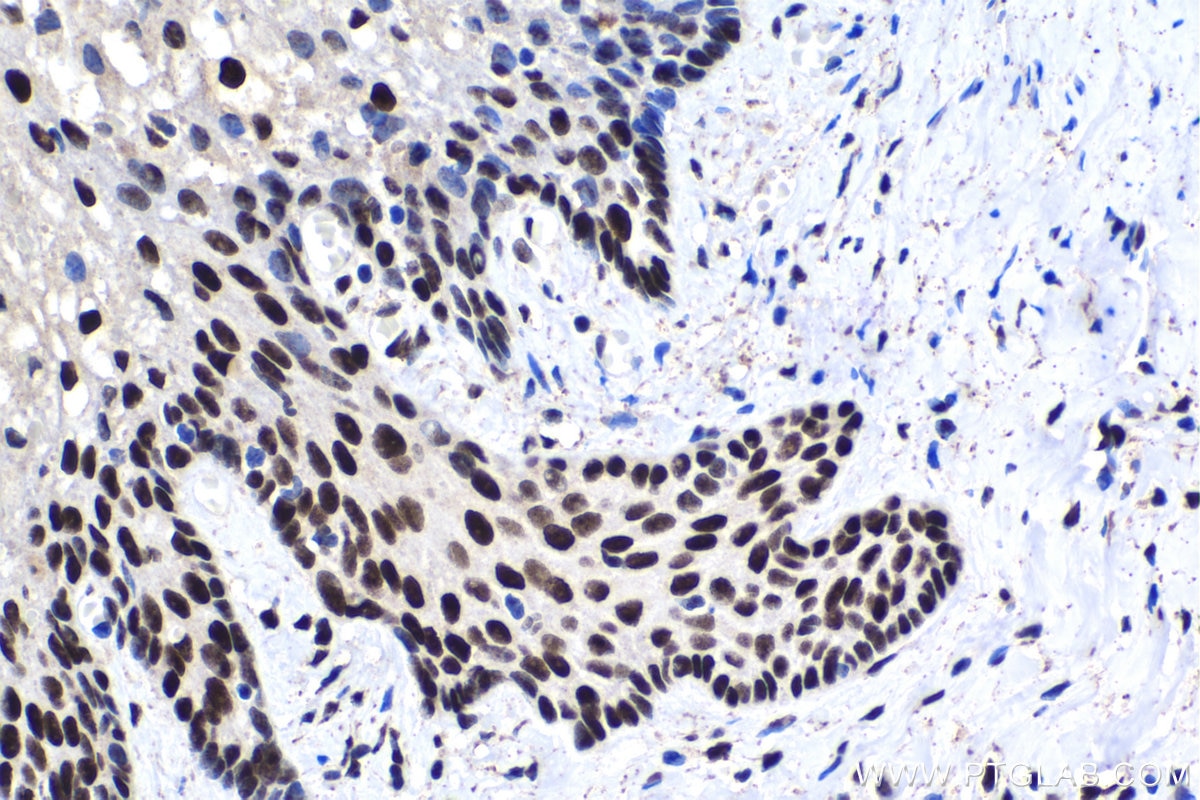 Immunohistochemical analysis of paraffin-embedded human cervical cancer tissue slide using KHC1509 (JUN IHC Kit).