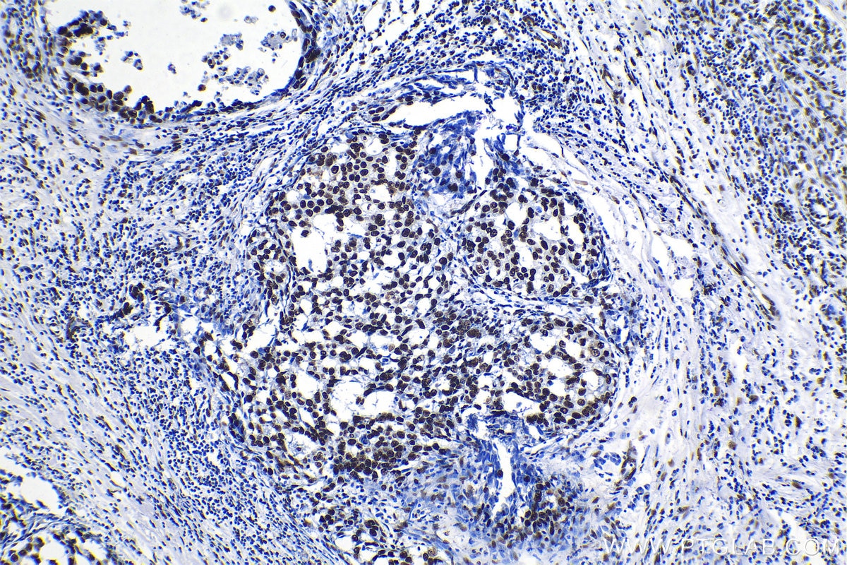 Immunohistochemical analysis of paraffin-embedded human breast cancer tissue slide using KHC1178 (KAP1 IHC Kit).