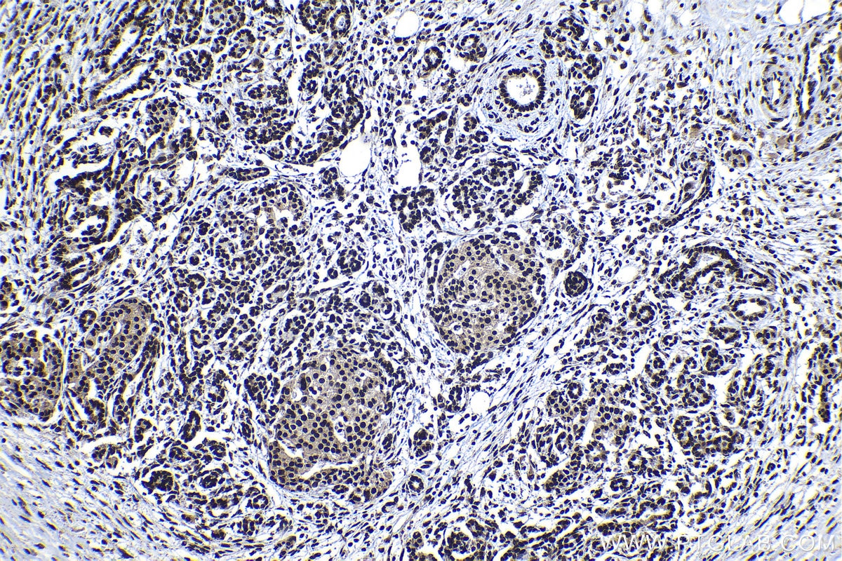 Immunohistochemical analysis of paraffin-embedded human pancreas cancer tissue slide using KHC1178 (KAP1 IHC Kit).