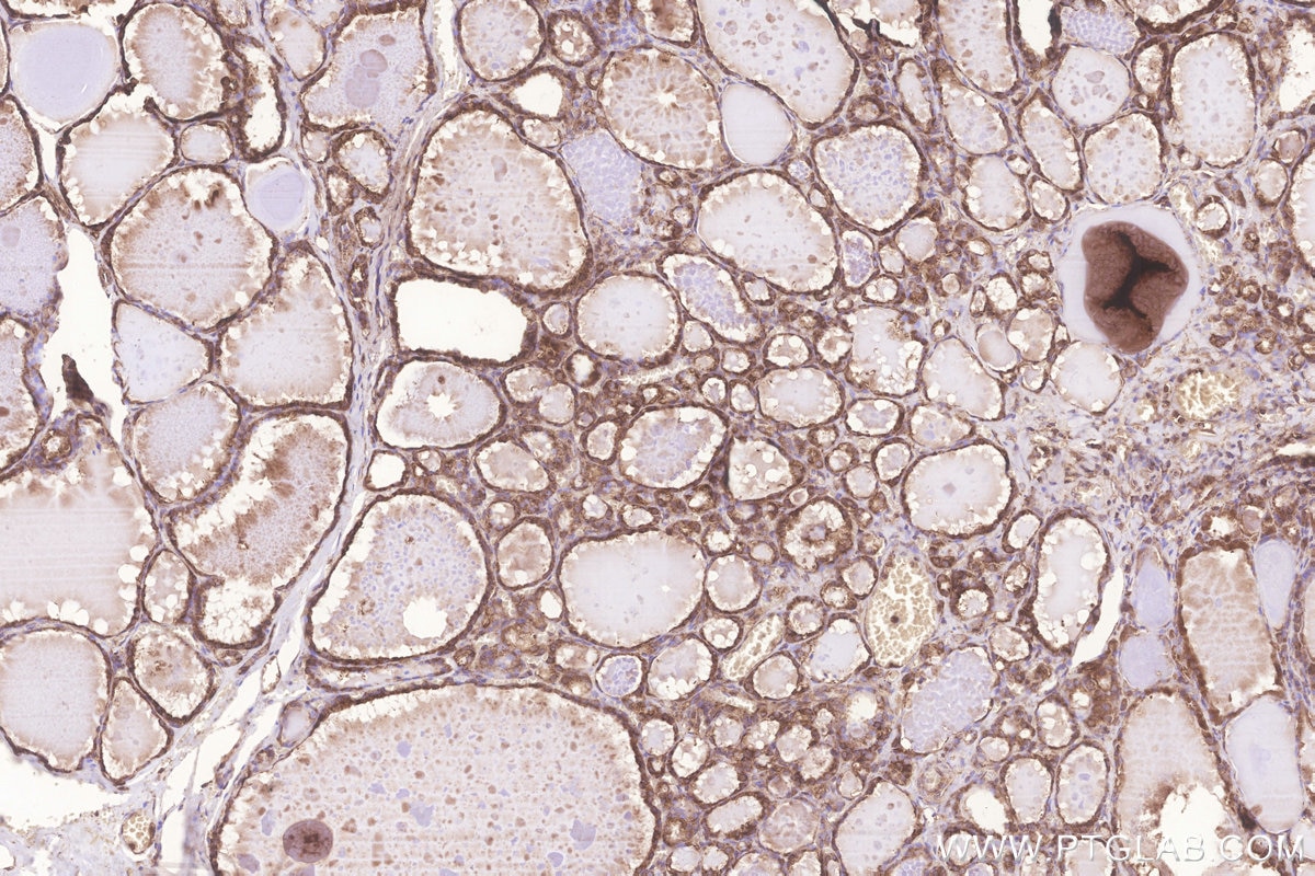 Immunohistochemical analysis of paraffin-embedded human thyroid cancer tissue slide using KHC3255 (KARS IHC Kit).