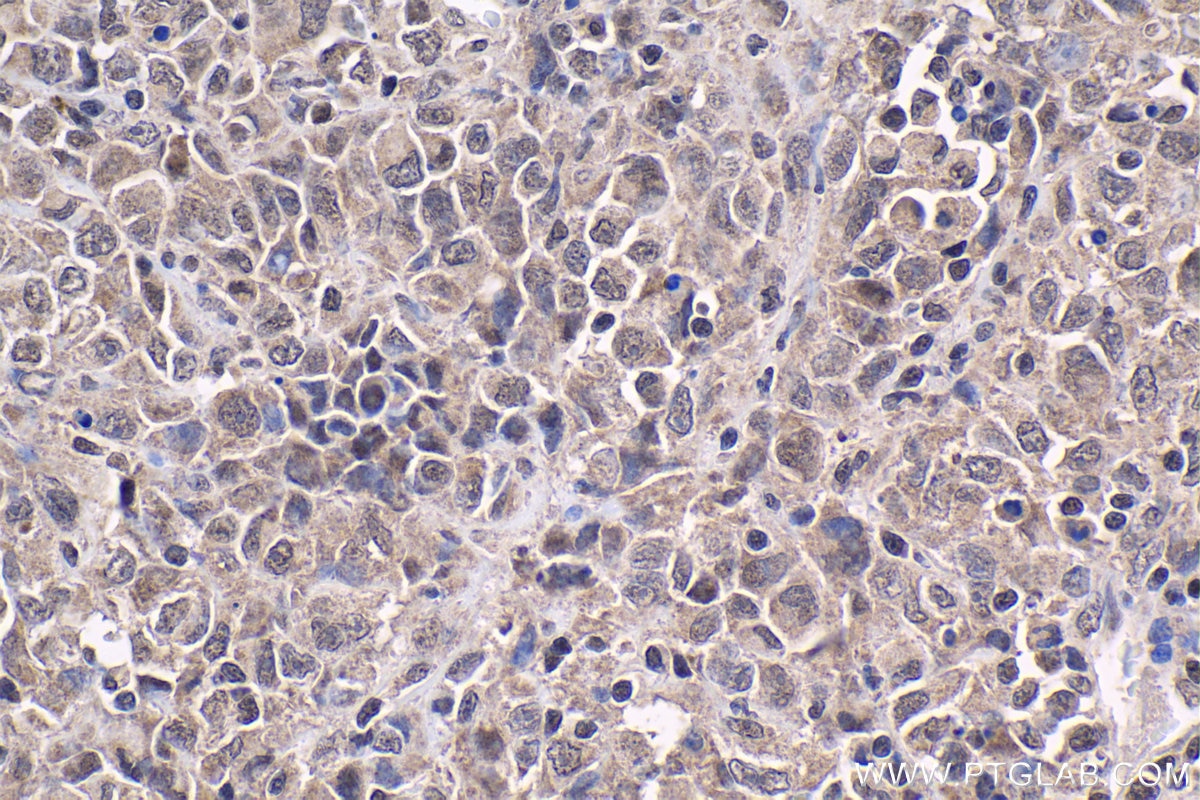 Immunohistochemical analysis of paraffin-embedded human malignant melanoma tissue slide using KHC1862 (KAT5 IHC Kit).