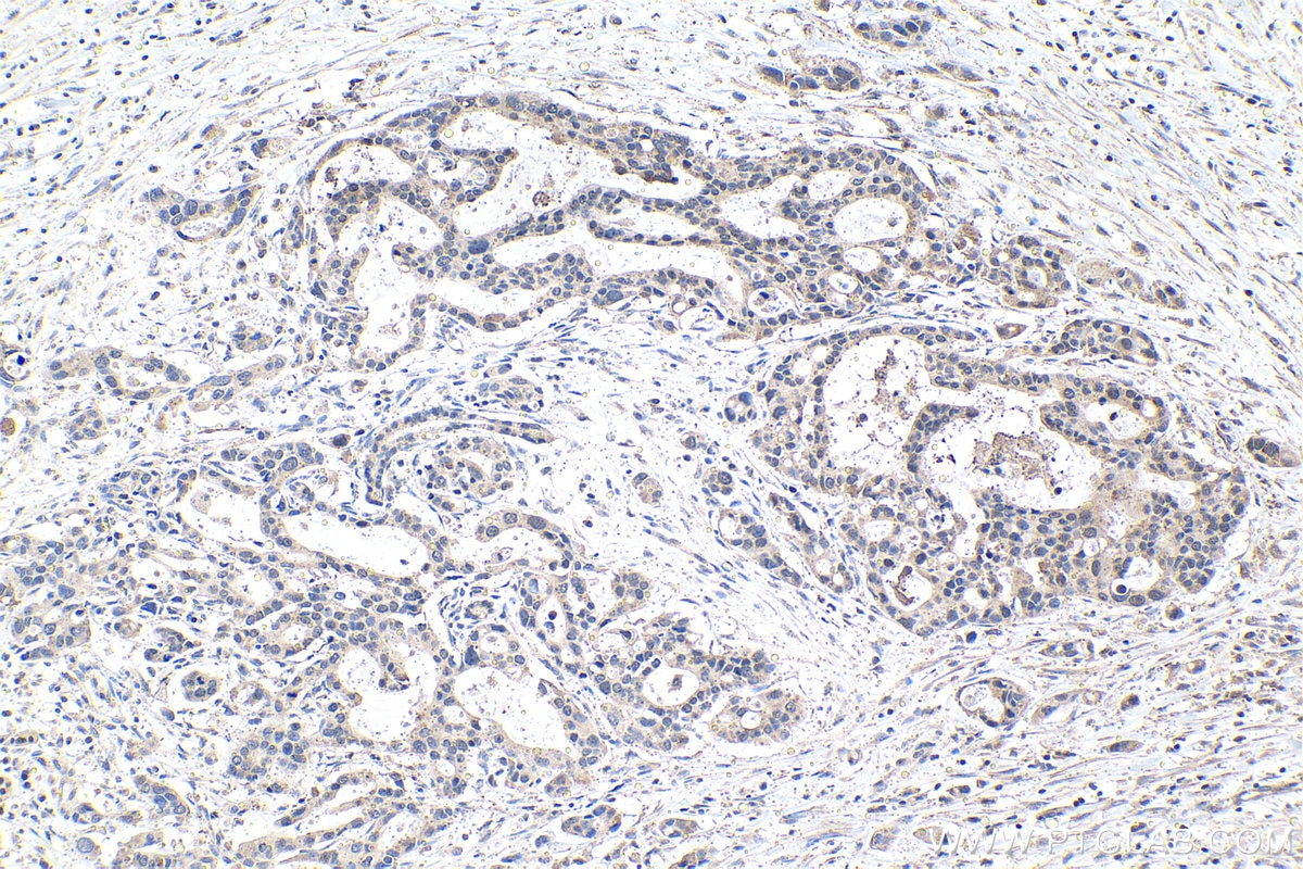 Immunohistochemical analysis of paraffin-embedded human pancreas cancer tissue slide using KHC1491 (KAT7/MYST2 IHC Kit).