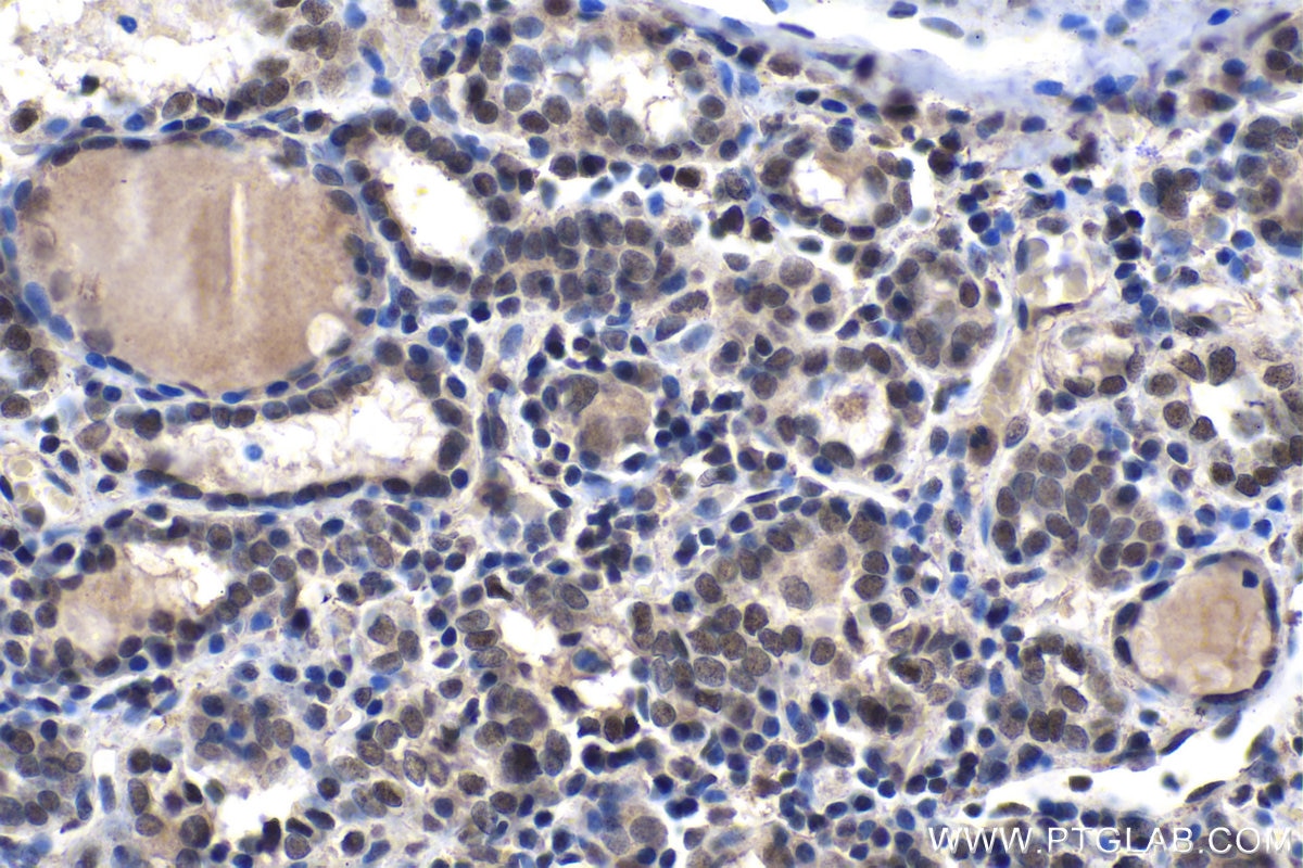 Immunohistochemical analysis of paraffin-embedded human thyroid cancer tissue slide using KHC1491 (KAT7/MYST2 IHC Kit).